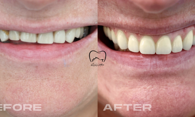 All-on-4 Implant Rehabilitation Clinical Case in Ryde