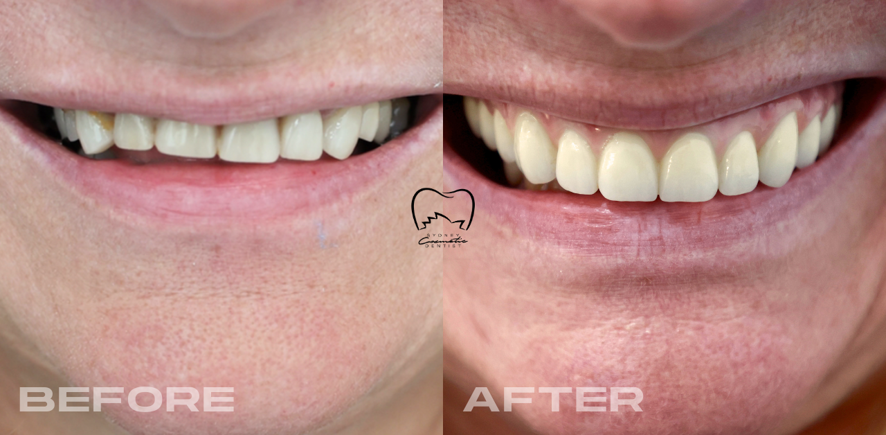 All-on-4 Implant Rehabilitation Clinical Case in Ryde
