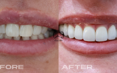 Anterior Veneers Clinical Case in Vaucluse