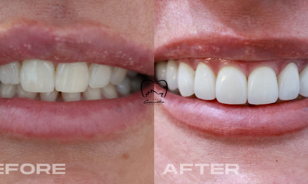 Anterior Veneers Clinical Case in Vaucluse