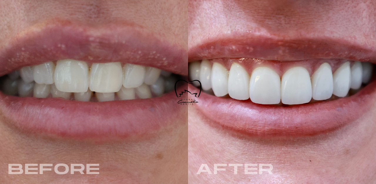Anterior Veneers Clinical Case in Vaucluse
