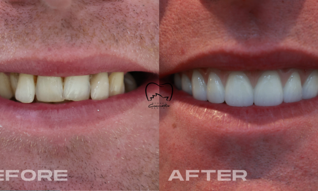 Full Arch Implants Clinical Case in Zetland