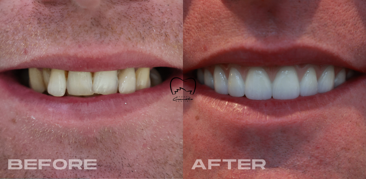 Full Arch Implants Clinical Case in Zetland