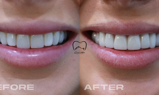Porcelain Veneers Clinical Case in Double Bay