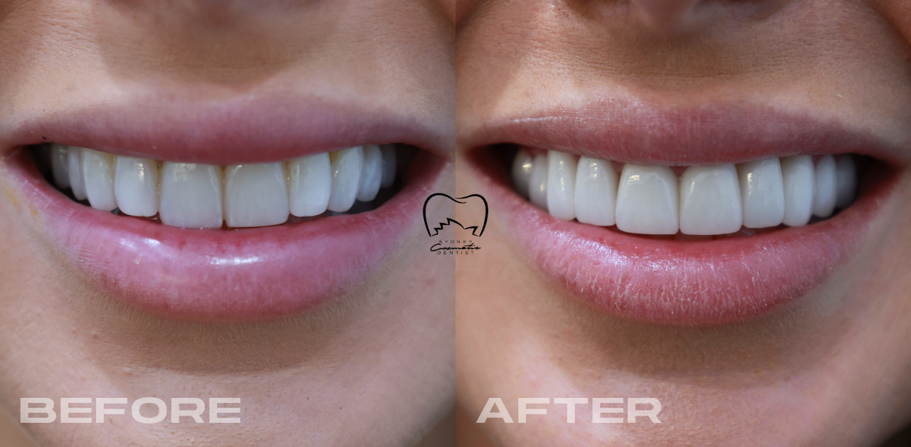 Porcelain Veneers Clinical Case in Double Bay
