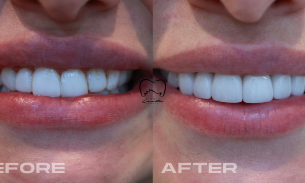 Smile Design Veneers Clinical Case in Dulwich Hill