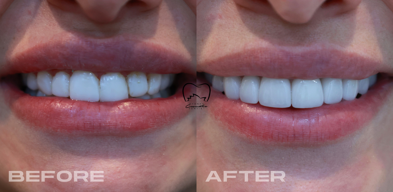 Smile Design Veneers Clinical Case in Dulwich Hill