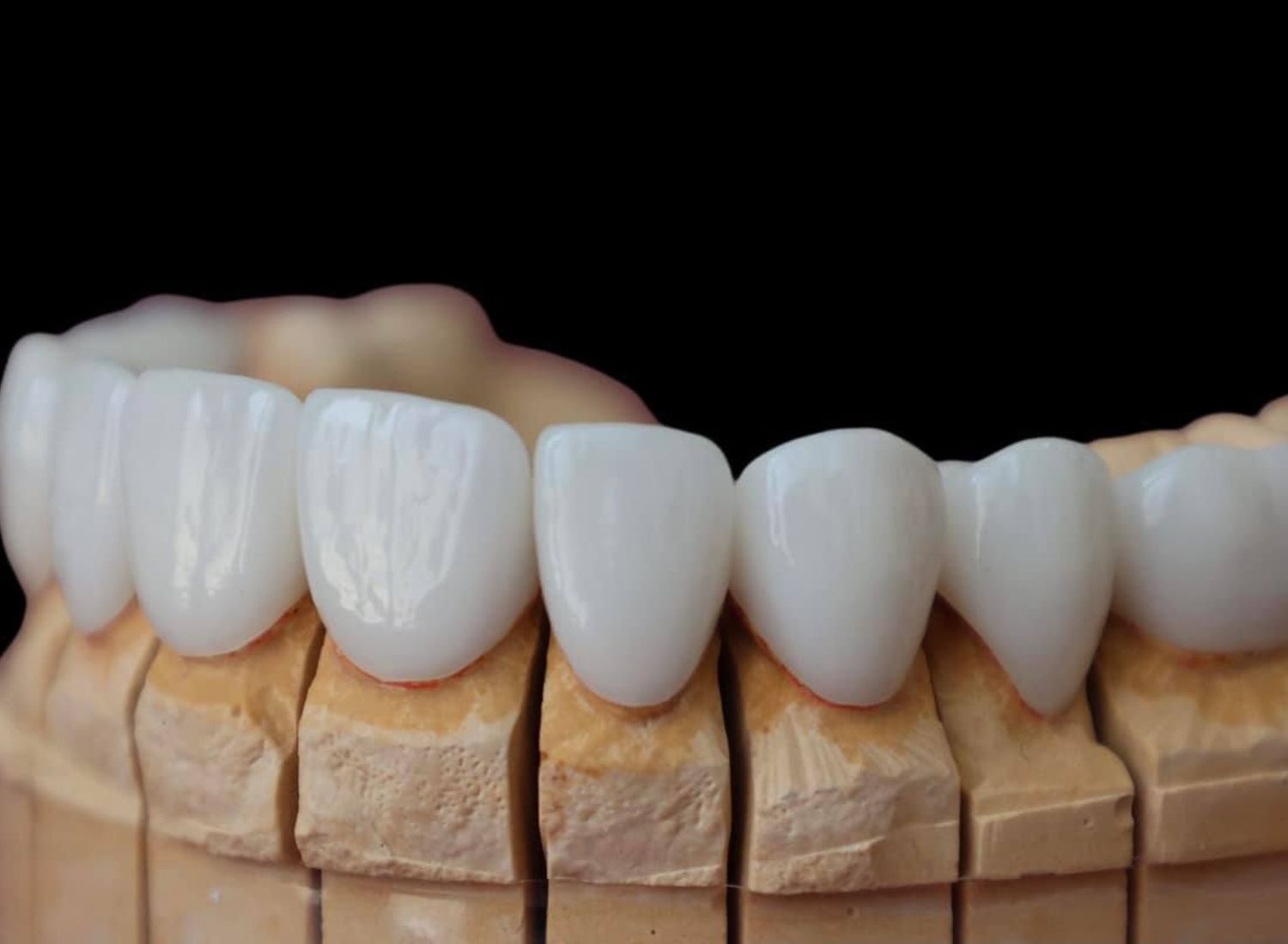 What, Exactly, Are Dental Veneers In Bondi, Bondi Junction, Sydney - Sydney Cosmetic Dentist