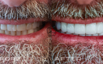 Full Mouth Veneers Clinical Case in Bondi Junction