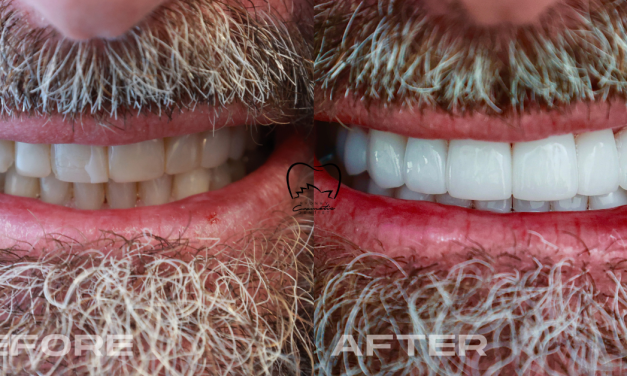 Full Mouth Veneers Clinical Case in Bondi Junction