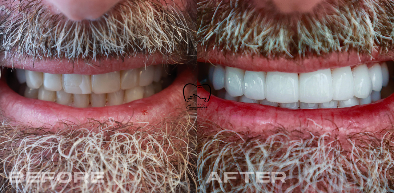 Full Mouth Veneers Clinical Case in Bondi Junction