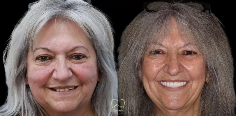 All-on-4 Implant Rehabilitation Clinical Case in Ryde