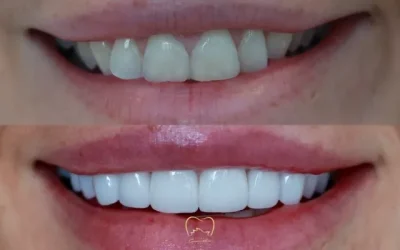 Anterior Veneers Clinical Case in Vaucluse