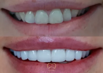Anterior Veneers Clinical Case in Vaucluse