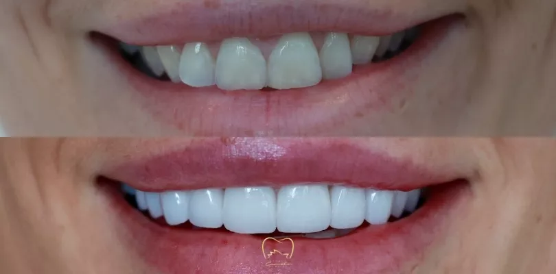Anterior Veneers Clinical Case in Vaucluse