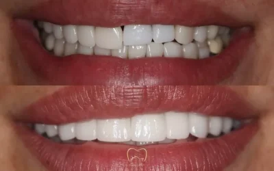Full Arch Implants Clinical Case in Zetland