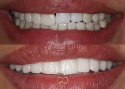 Full Arch Implants Clinical Case in Zetland