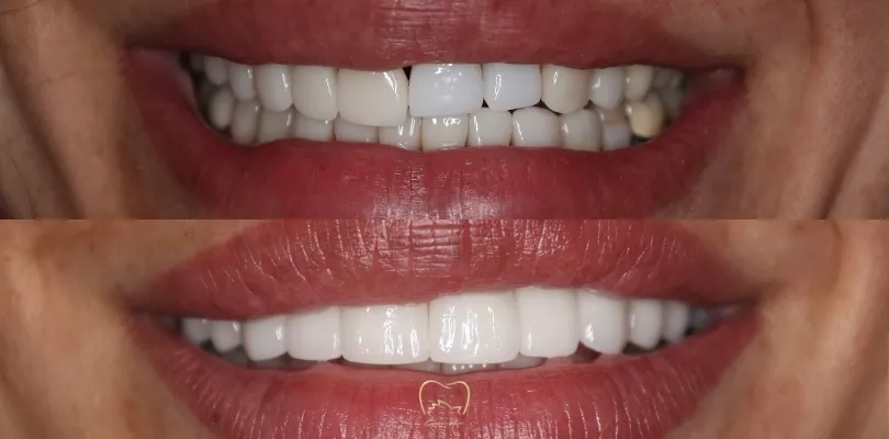 Full Arch Implants Clinical Case in Zetland