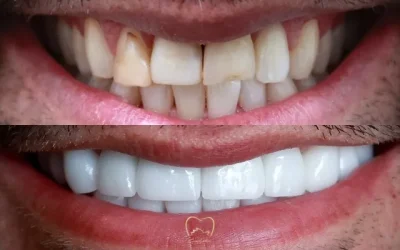 Full Mouth Veneers Clinical Case in Bondi Junction