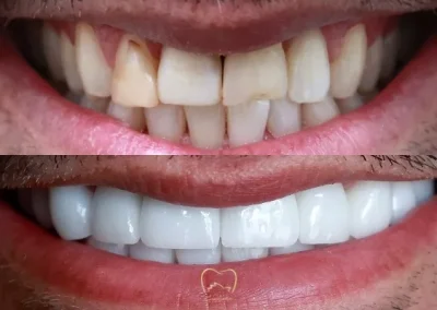 Full Mouth Veneers Clinical Case in Bondi Junction