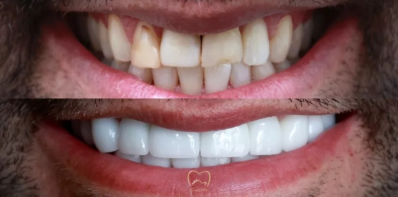 Full Mouth Veneers Clinical Case in Bondi Junction