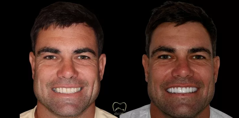 Porcelain Veneers Clinical Case in Double Bay