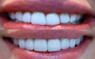 Smile Design Veneers Clinical Case in Dulwich Hill