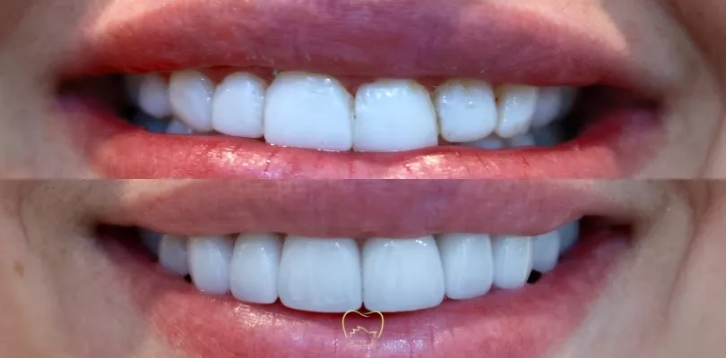 Smile Design Veneers Clinical Case in Dulwich Hill